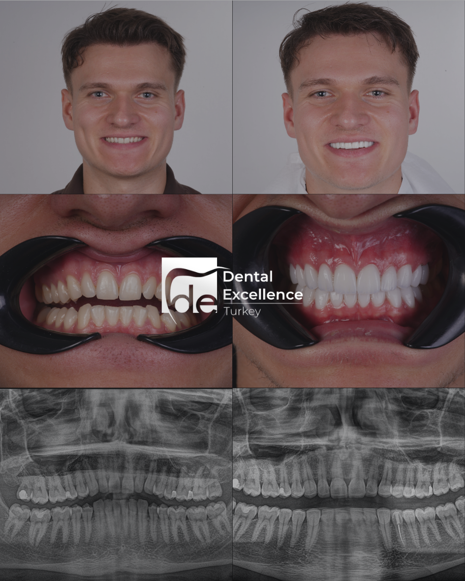 Before After Treatment